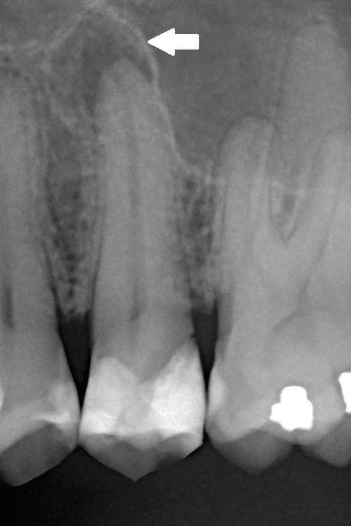 Radiographie d'une parodontite apicale chronique