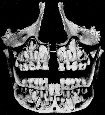 Dents de lait (deciduales) et germes de dents permanentes