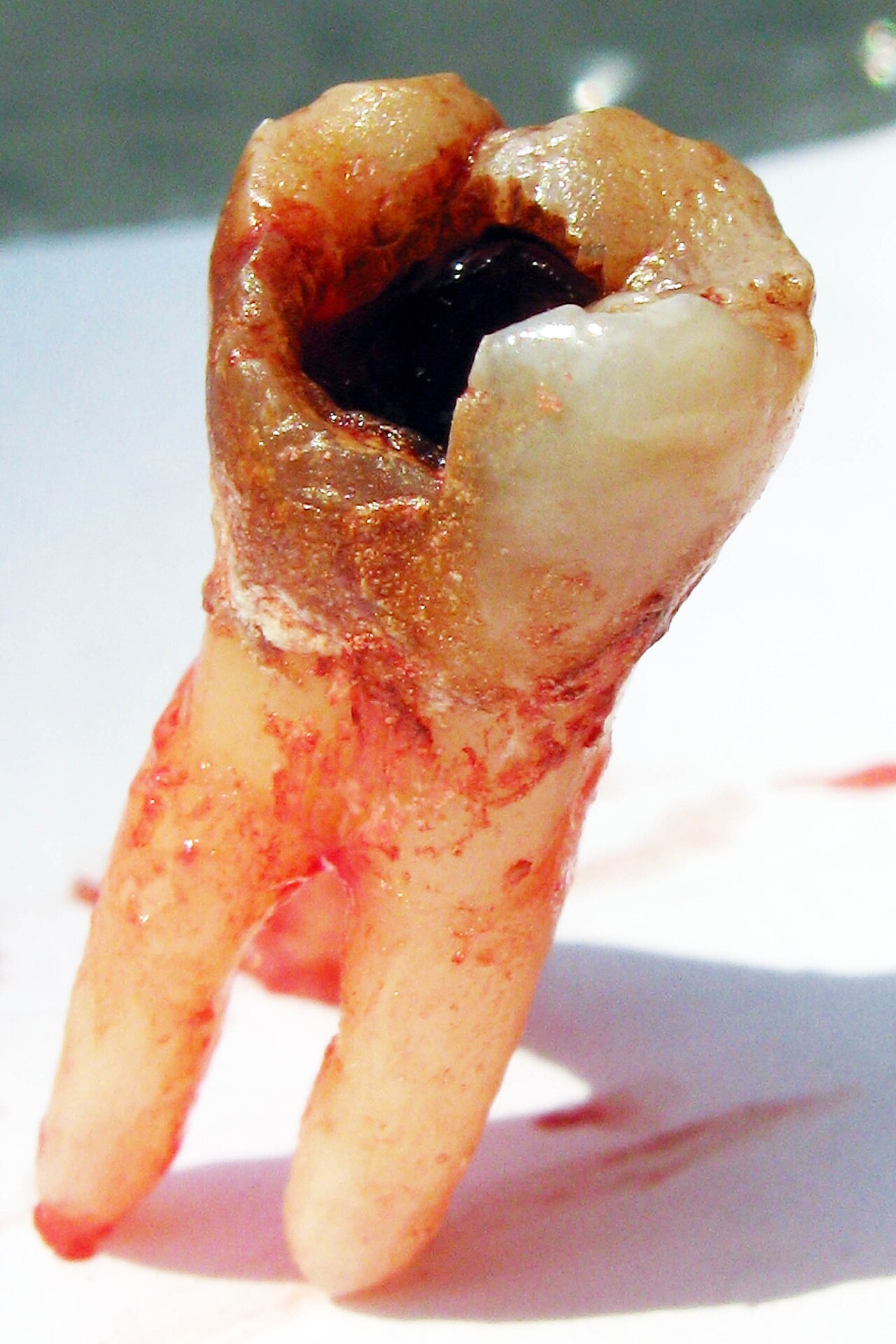 Cavite dentaire - cause frequente de rage de dents