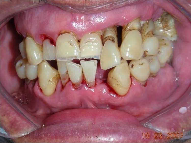 Parodontite chronique severe