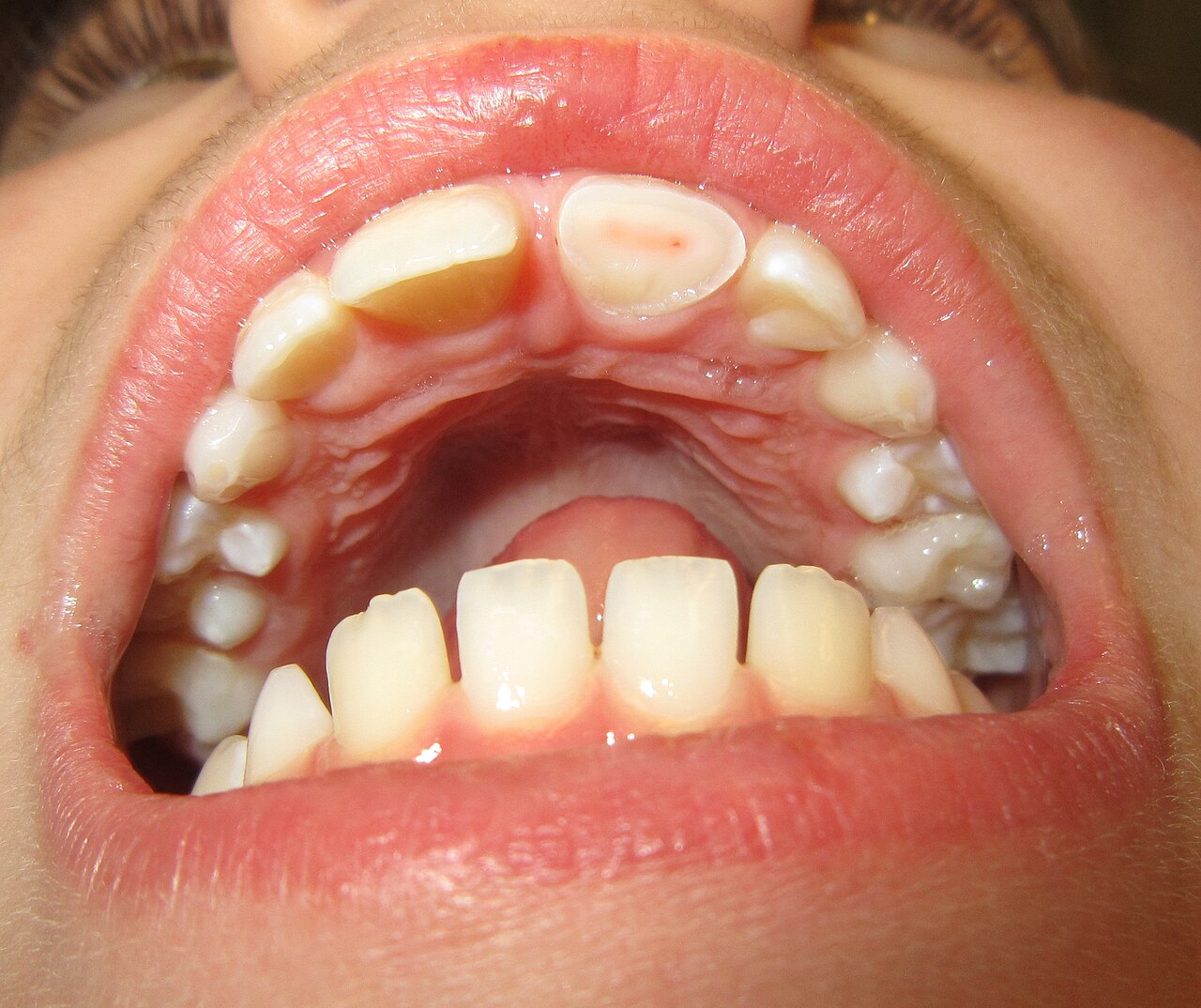 Fracture dentaire suite a un traumatisme