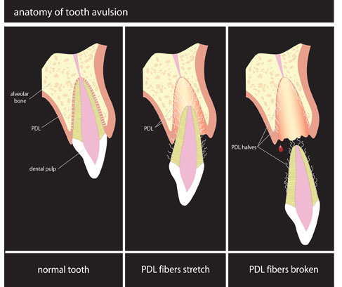 Avulsion d'une dent definitive chez l'enfant